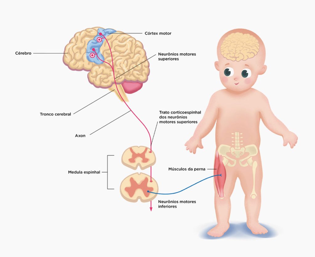 Imagem Ilustrativa da Doença Genética Rara de Atrofia Muscular Espinhal (AME)